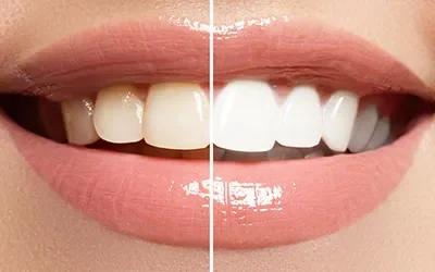 A Guide to Choosing the Right Dentist for Teeth Whitening in DLF Gurgaon