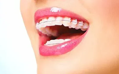 Brace Yourself: Benefits of Orthodontic Treatment