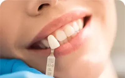 Dental Veneers