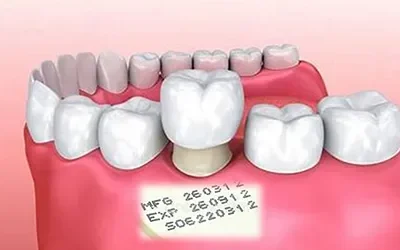 Does Your Dental Crown Comes with An Expiry Date?