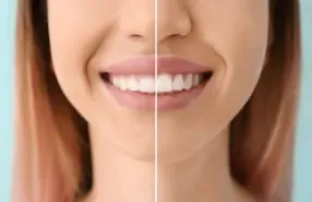 Smile Makeover