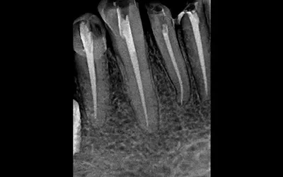 Is The Root Canal Treatment Painful: Let’s Take The Pain Out Of It