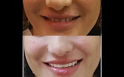 Know Your Smile Makeover Journey: What to Expect (From Us)