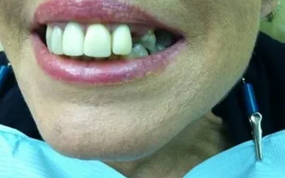 Missing teeth? Why Replace it?