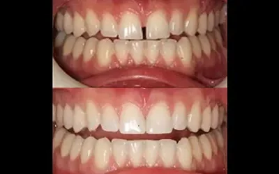 The Beauty of Direct Dental Veneers