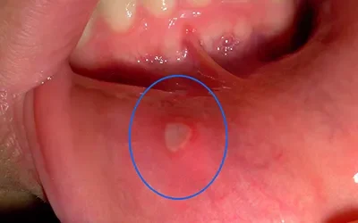 The Painful Truth: Understanding Oral Ulcers