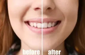 Smile Makeover