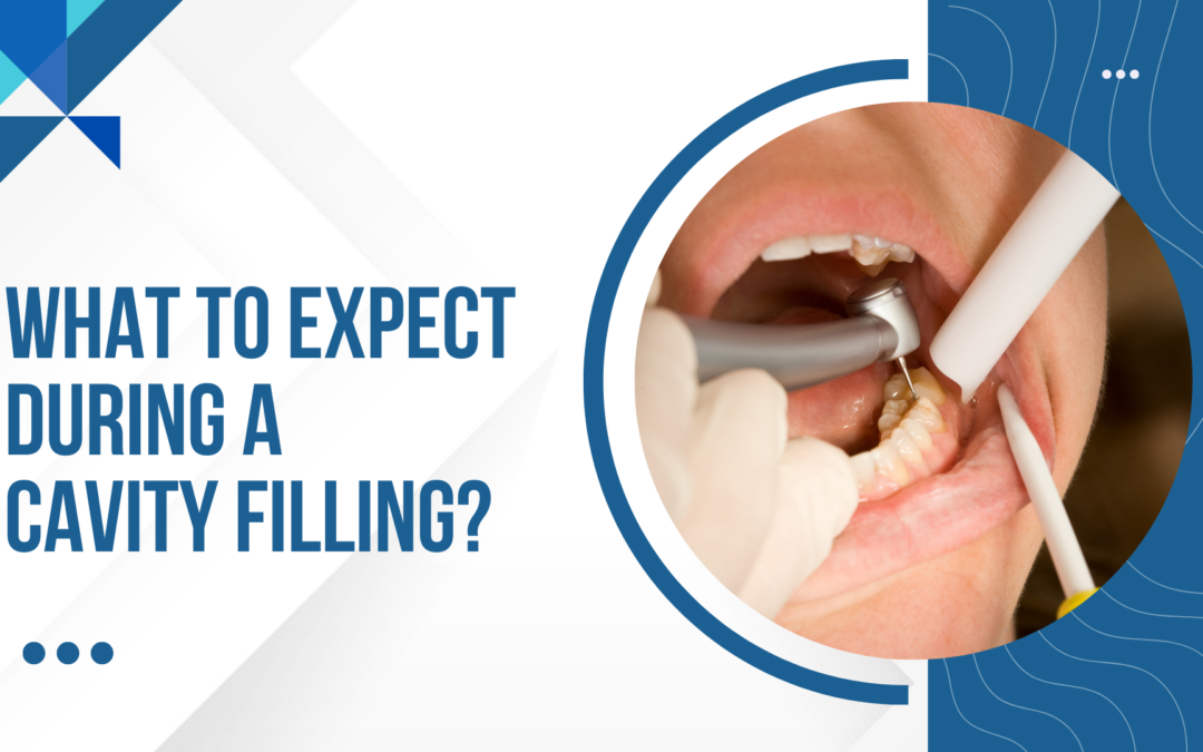 WHAT TO EXPECT DURING A CAVITY FILLING?