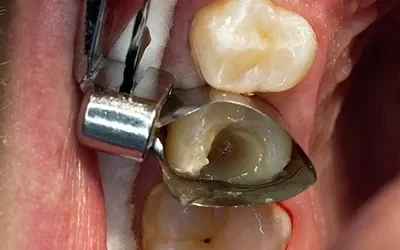 WHAT TO EXPECT DURING A CAVITY FILLING?