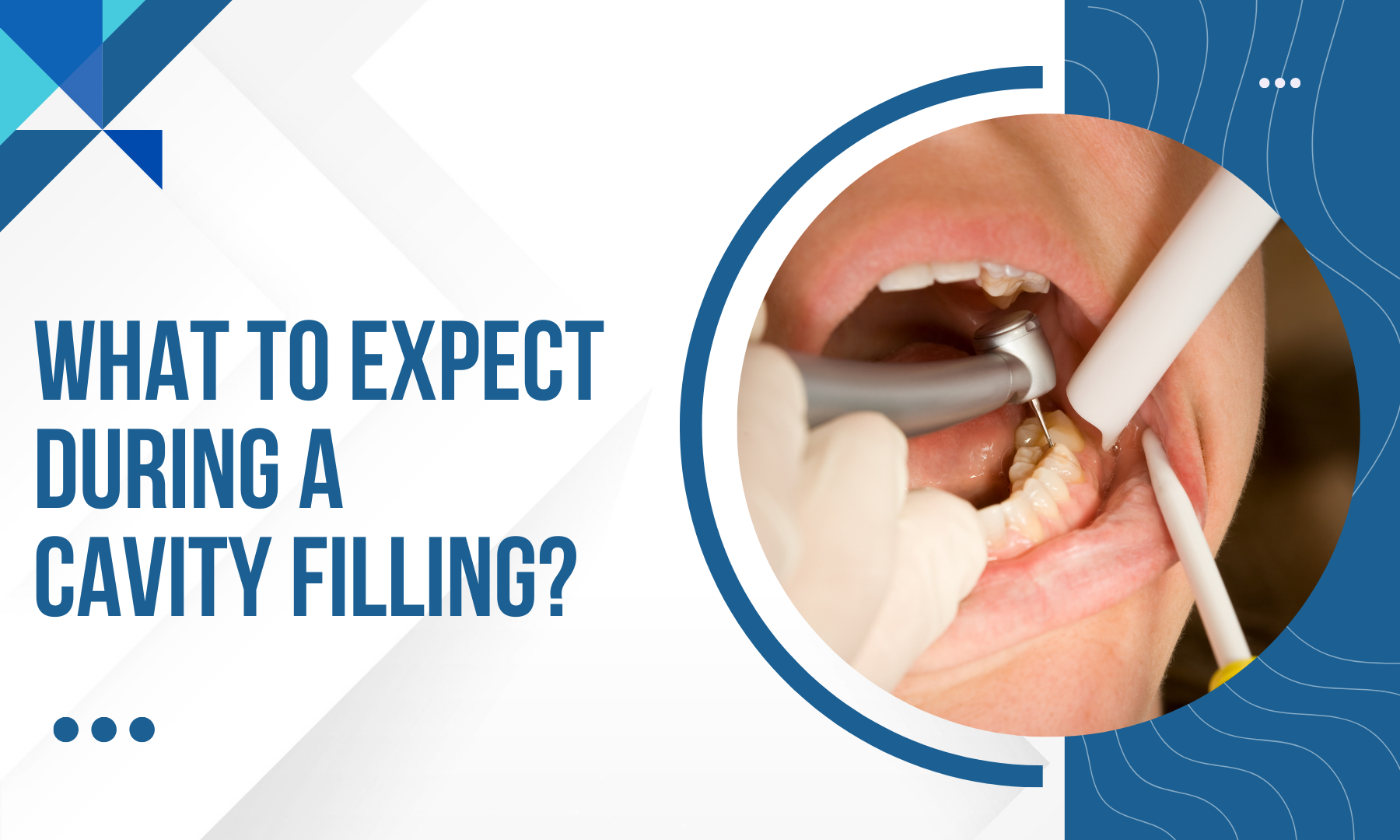 WHAT TO EXPECT DURING A CAVITY FILLING