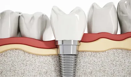 When Dental Implants are NOT An Option?