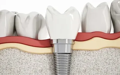 Why Dental Implants Fail?