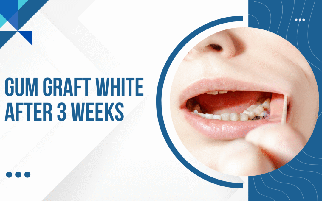Gum_graft_white_after_3_weeks
