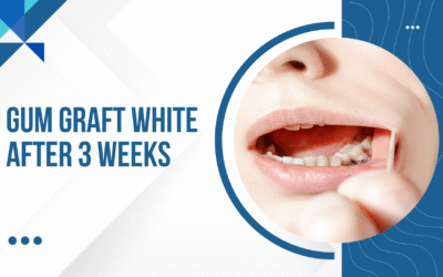 Gum graft white after 3 weeks