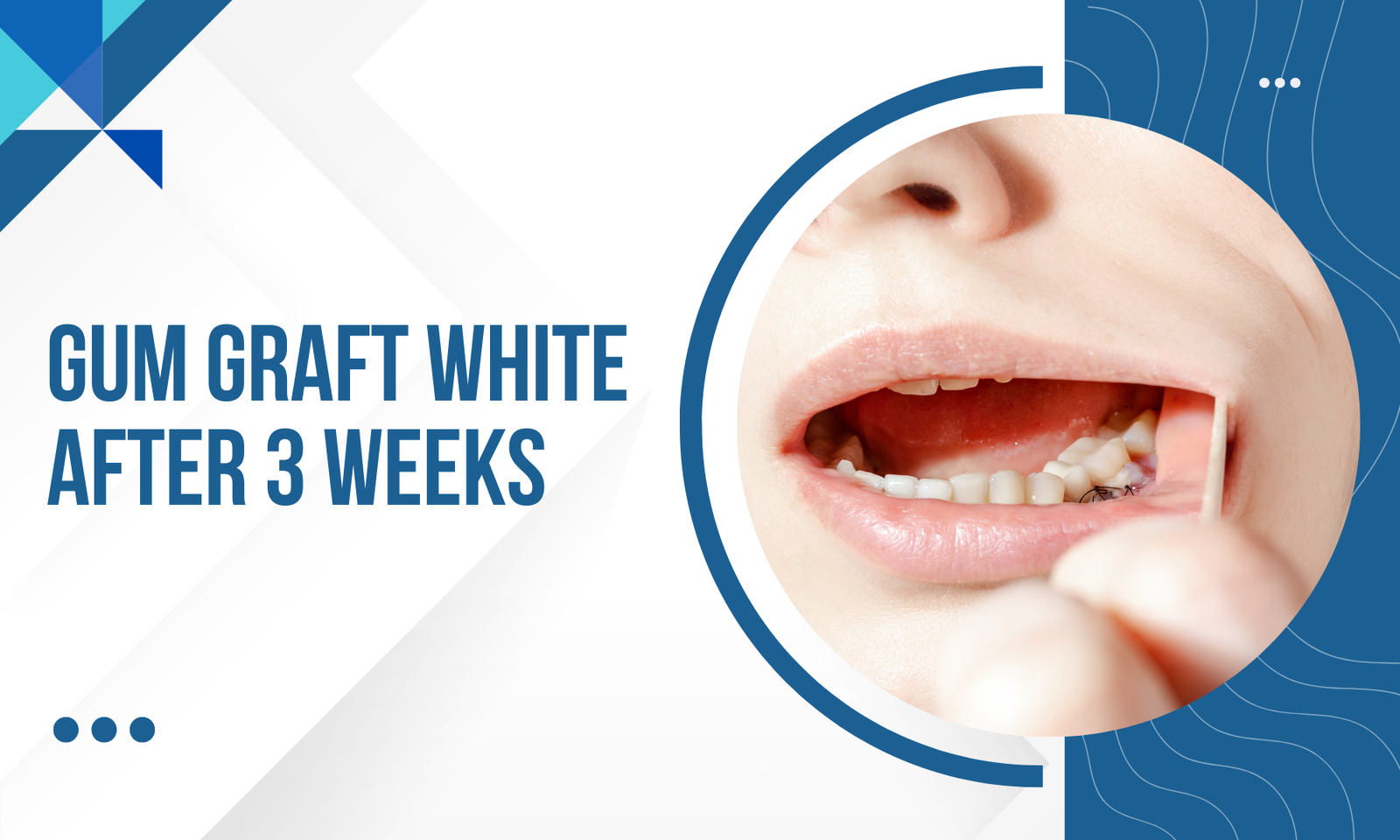 Gum_graft_white_after_3_weeks