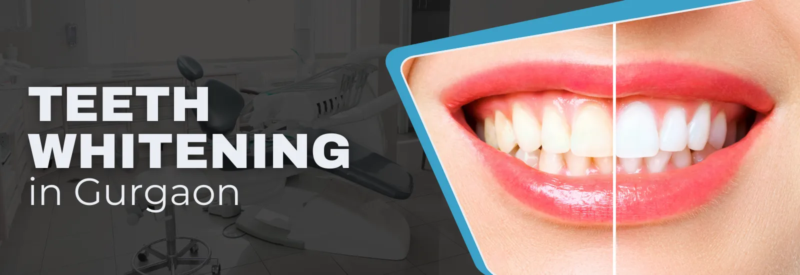imgi_16_Teeth_Whitening_1