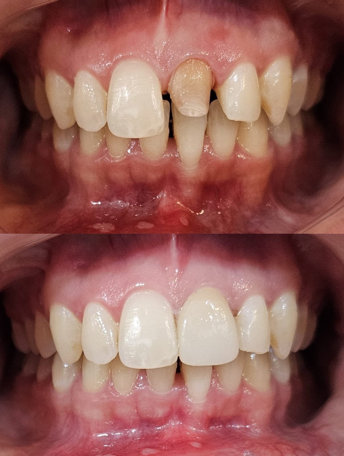 Transforming Smiles: Non-Vital Front Tooth Treatment at EXL Dentist Clinic in Gurgaon Transforming Smiles: Non-Vital Front Tooth Treatment at EXL Dentist Clinic in Gurgaon