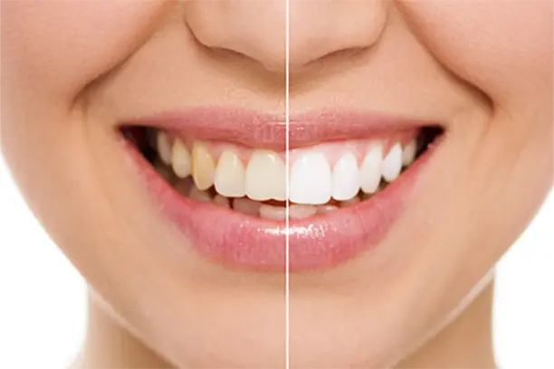 dental-implants