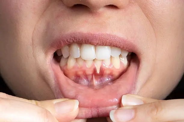 invisalign-treatment