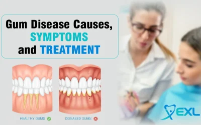 Gum Disease Causes, Symptoms, and Treatment