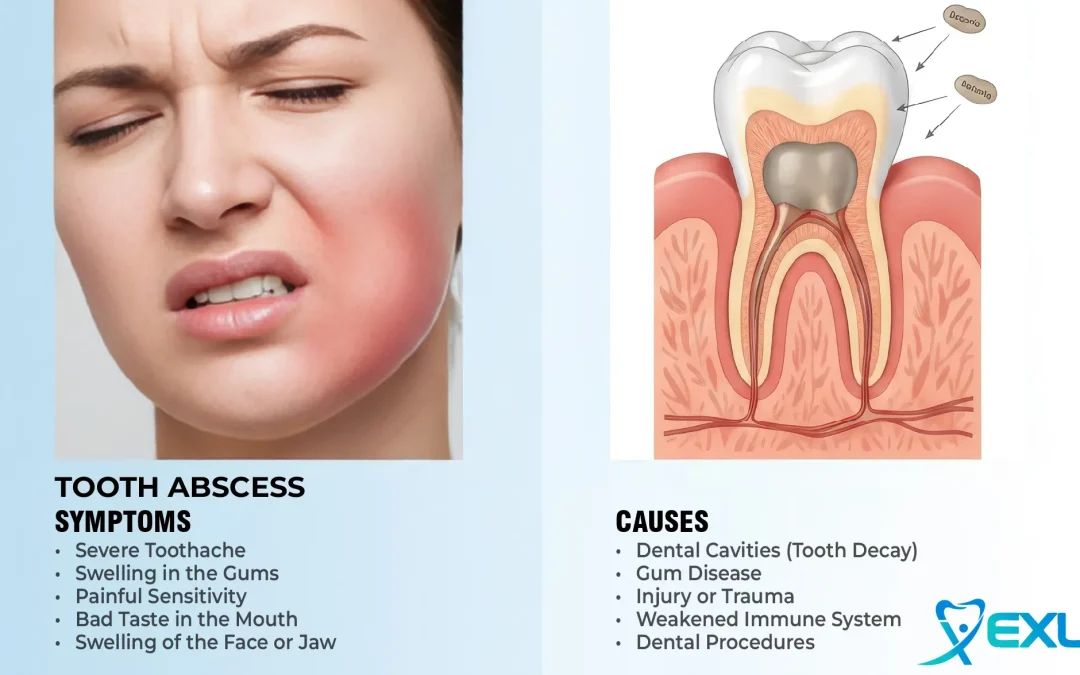 Tooth abscess – Symptoms & causes