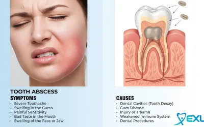 Tooth abscess – Symptoms & causes